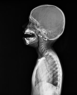 Professional Water's view X-ray of a human skull showing the paranasal sinuses and maxillary cavities.