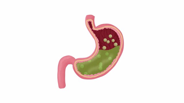 Gastroesophageal reflux disease cartoon animation. gerd animation.