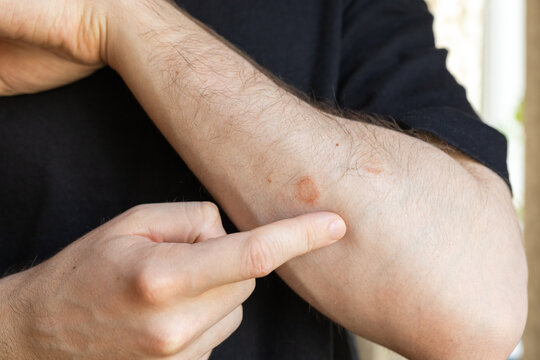 Ringworm fungal skin infection on male arm close up, dermatology problem