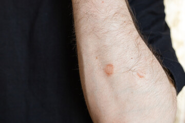 Naklejka premium Circular skin rash on male arm close up, dermatological condition or fungal infection 