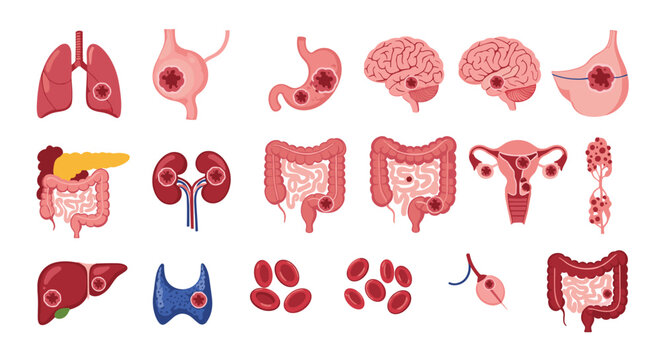 Medical illustration showing various human organs affected by cancer lesions including brain, lungs, stomach, liver, and kidneys.