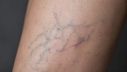 Fototapeta premium Detailed texture of varicose veins on human leg, dermatology and vascular health concept