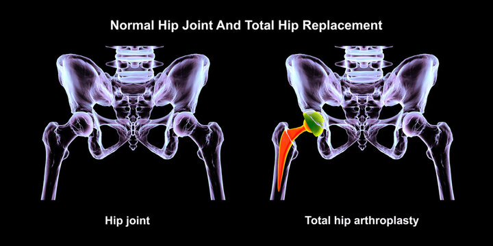 Normal healthy hip joint with intact femoral head, acetabulum, articular cartilage and joint space, and total hip replacement, 3D illustration.