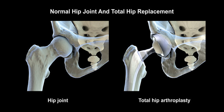Normal healthy hip joint with intact femoral head, acetabulum, articular cartilage and joint space, and total hip replacement, 3D illustration.