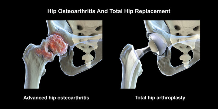 Advanced hip osteoarthritis with joint space narrowing, osteophytes and cartilage loss, and total hip replacement prosthesis, 3D illustration.