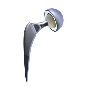 Total hip replacement prosthesis. Shows femoral stem with head, acetabular cup with liner, and articulation in the hip joint. 3D illustration.