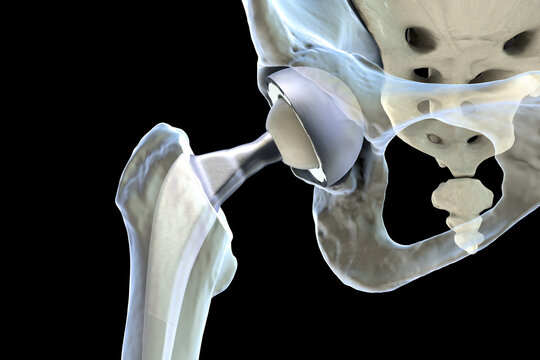 Total hip replacement prosthesis. Shows femoral stem with head, acetabular cup with liner, and articulation in the hip joint. 3D illustration.