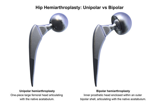 Two types of hip hemiarthroplasty: unipolar versus bipolar prosthesis. 3D illustration.
