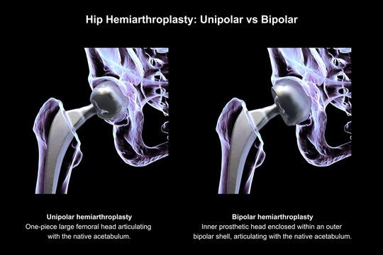 Two types of hip hemiarthroplasty: unipolar versus bipolar prosthesis. 3D illustration.