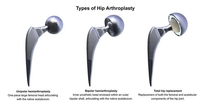 Three types of hip prostheses: unipolar hemiarthroplasty, bipolar hemiarthroplasty and total hip replacement, 3D illustration