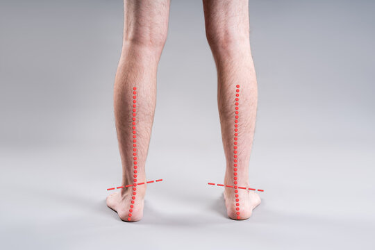 Flat feet and valgus deformity diagnostic. Male legs back view with red axis lines showing foot alignment problem