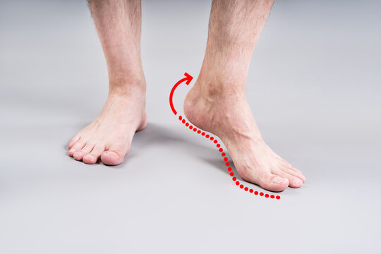 Flat feet correction exercise. Male foot with red arrow showing arch lifting movement, podiatry therapy concept