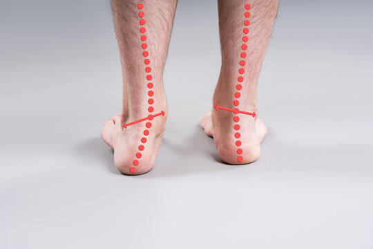 Flat feet and valgus deformity diagnostic. Male legs back view with red axis lines showing foot alignment problem