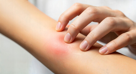 Fototapeta premium Person gently scratching an irritated arm with red rash 