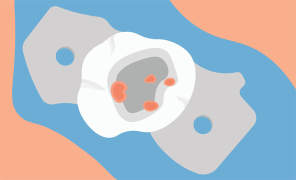 Top View of Decayed Tooth with Gutta-Percha