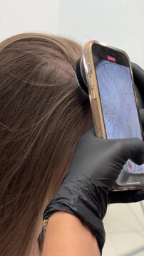Scalp trichoscopy examination with digital dermatoscope close up, dermatologist diagnostic procedure in clinic