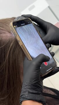 Scalp trichoscopy examination with digital dermatoscope close up, dermatologist diagnostic procedure in clinic