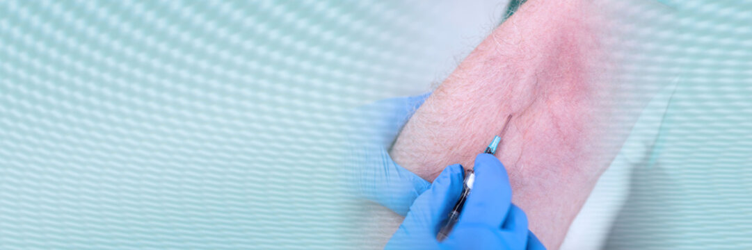 Injection of a catheter in the arm; panoramic banner