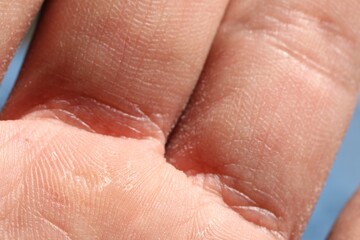 Fototapeta premium Man with dry skin on his hand, closeup