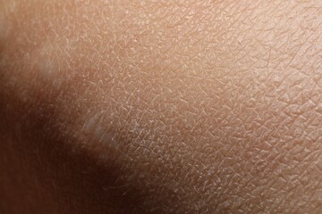 Fototapeta premium Texture of dry skin as background, closeup