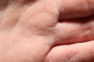 Fototapeta premium Man with dry skin on his hand, closeup
