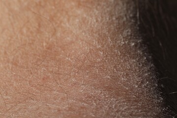 Fototapeta premium Texture of dry skin as background, closeup