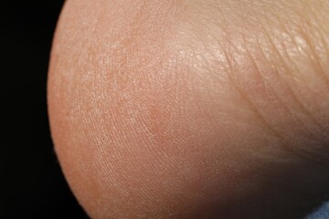 Fototapeta premium Man with dry skin on his foot against black background, closeup
