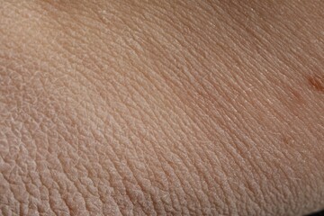 Fototapeta premium Texture of dry skin as background, closeup