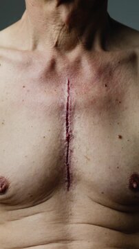 Mature person chest with vertical surgical sternotomy incision scar extreme close up view