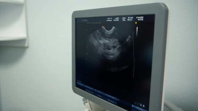 Closeup of ultrasound monitor shows diagnostic scan, sterile room with grayscale sonogram on angled display, measurement overlays and onscreen data visible. Technical equipment in medical clinic