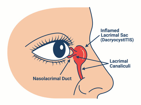 Illustration of dacryocystitis showing inflammation of the lacrimal sac
