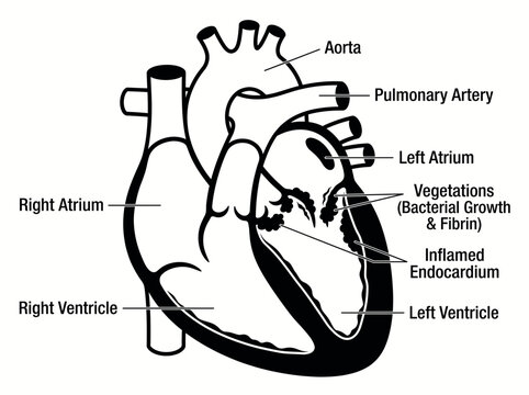 Anatomy of the human heart showing infective endocarditis