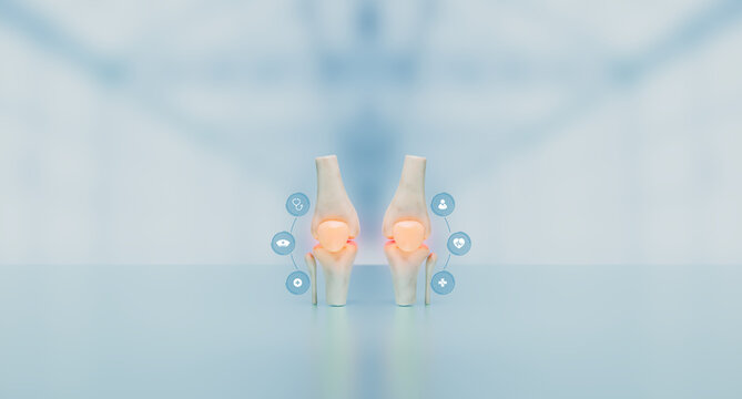 Three-dimensional representation of the patella and femur. Skeletal anatomy applied to chondropathy and bone degeneration. Sports medicine and surgery. Bokeh background