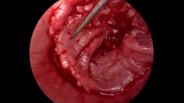 Microsurgical Endoscopic Otologic Procedure in Operating Room