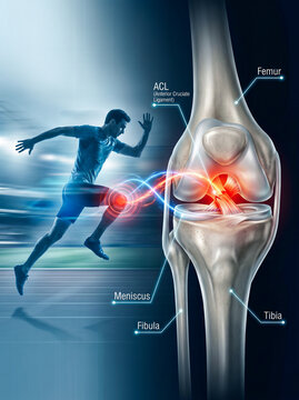 A runner suffers knee pain while detailed knee anatomy is shown.