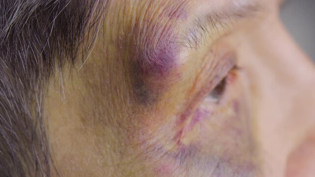 An elderly woman fell and has a swollen, bruised eyebrow and eye.