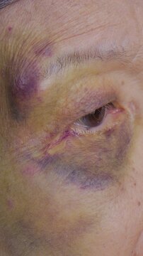 An elderly woman fell and has a swollen, bruised eyebrow and eye.