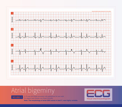 A sinus beat and an atrial premature beat alternate. The QRS complex of premature atrial contractions is accompanied by varying degrees of iintraventricular aberrant conduction.
