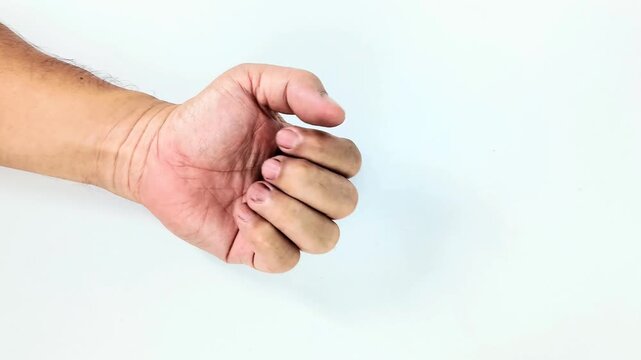 Male with trigger finger symptoms exhibits a middle finger that is difficult to straighten when opening the palm.