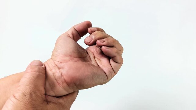 Male with trigger finger symptoms exhibits a middle finger that is difficult to straighten when opening the palm.