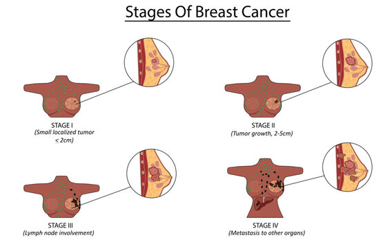 Stages of breast cancer vector illustration