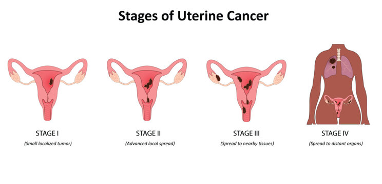 Stages of uterine cancer vector illustration