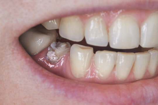 Human Lower Molar Showing Severe Tooth Decay And Broken Filling With Exposed Dentin And Adjacent Healthy Teeth In Open Mouth Close Up Dental Clinic Setting For Oral Examination.