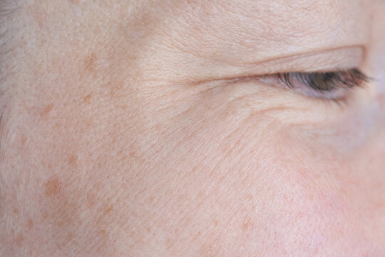 Outer Eye Area Showing Crow Feet Wrinkles And Age Spots In Close Up Clinical View On Temple And Cheek Under Neutral Soft Lighting For Dermatologic Evaluation.