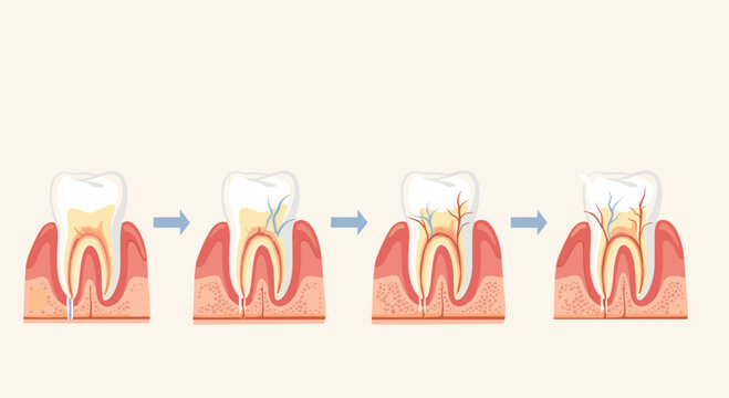 Medical diagram illustrating the stages of tooth decay from healthy enamel to deep infection and nerve damage in the gum tissue.