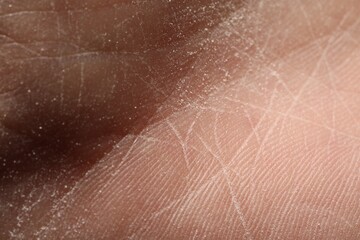 Fototapeta premium Man with dry skin on his hand, closeup