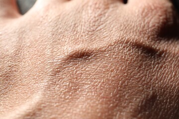 Fototapeta premium Man with dry skin on his hand, closeup
