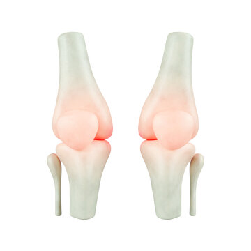 3D recreation of the bones of the human knee joint showing inflammation and anatomical visualization of pain in the patella and femur.