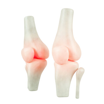 3D recreation of the bones of the human knee joint showing inflammation and anatomical visualization of pain in the patella and femur.