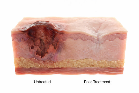 Skin cancer cross section showing untreated lesion and healed tissue
